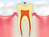 C0【ごく初期の虫歯】