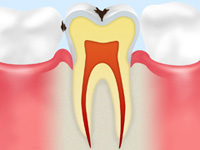 C1【エナメル質の虫歯】