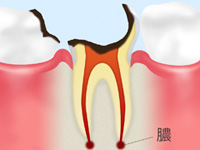 C4【歯根まで達した虫歯】
