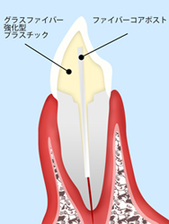 インレー（詰め物）