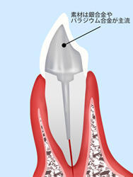 クラウン（被せ物）